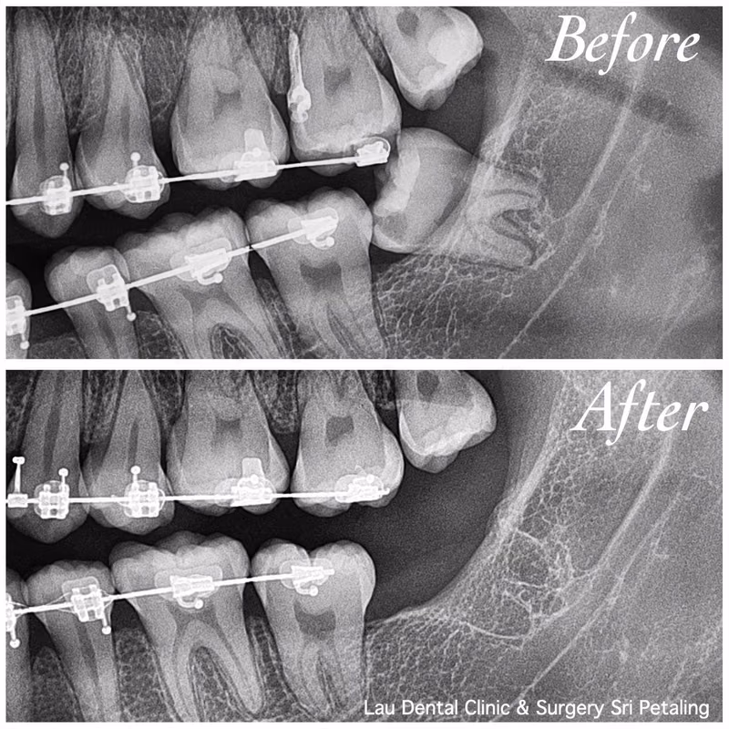 X-ray comparison of wisdom tooth extraction performed during braces treatment, showing healthy healing.