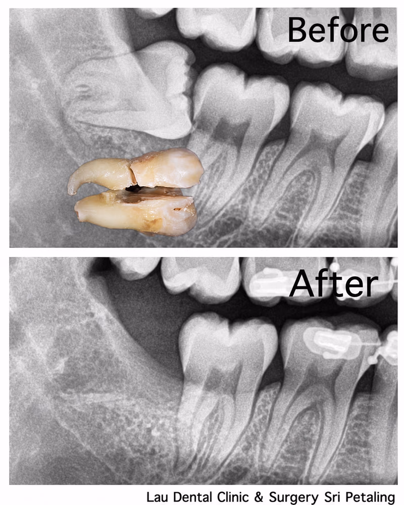 X-ray showing a wisdom tooth with a broken root before extraction and clean, complete healing after treatment.