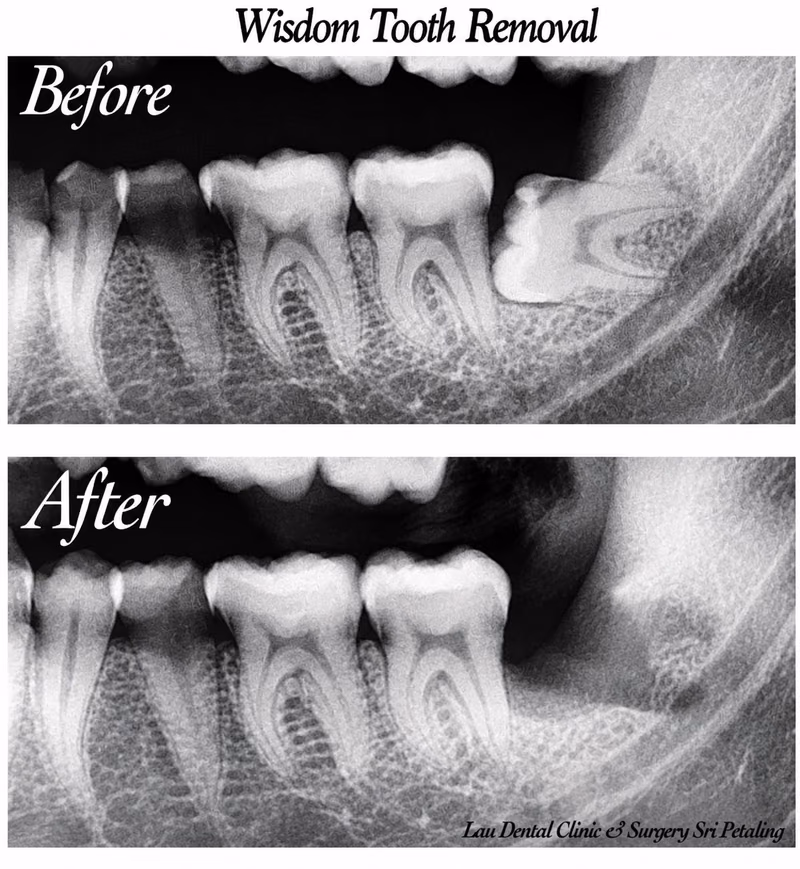 X-ray comparison showing wisdom tooth extraction near a back molar with healthy bone healing afterward.