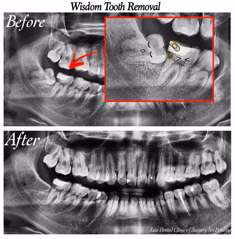 X-ray comparison of wisdom tooth extraction showing healthy bone healing after the surgical procedure.