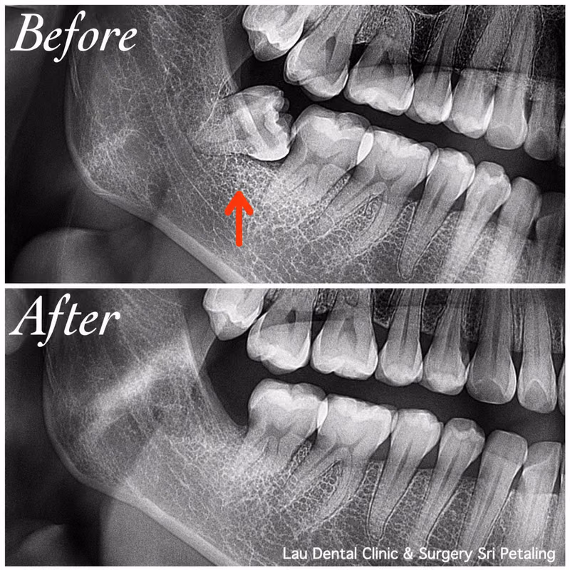 X-ray showing wisdom tooth pressure on neighboring teeth before extraction and healthy healing after.