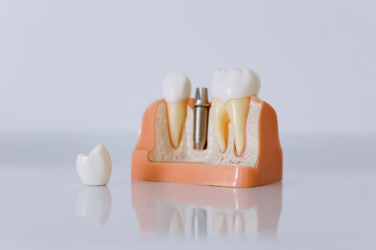 A dental study model showing implant fixtures seated in the jaw, used to plan how many implants a full arch needs.