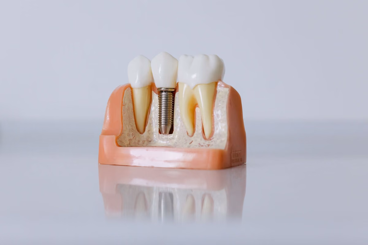 A cross-section dental model showing a titanium implant fixture in the jawbone with a crown on top, the three components inside a single-tooth implant price.
