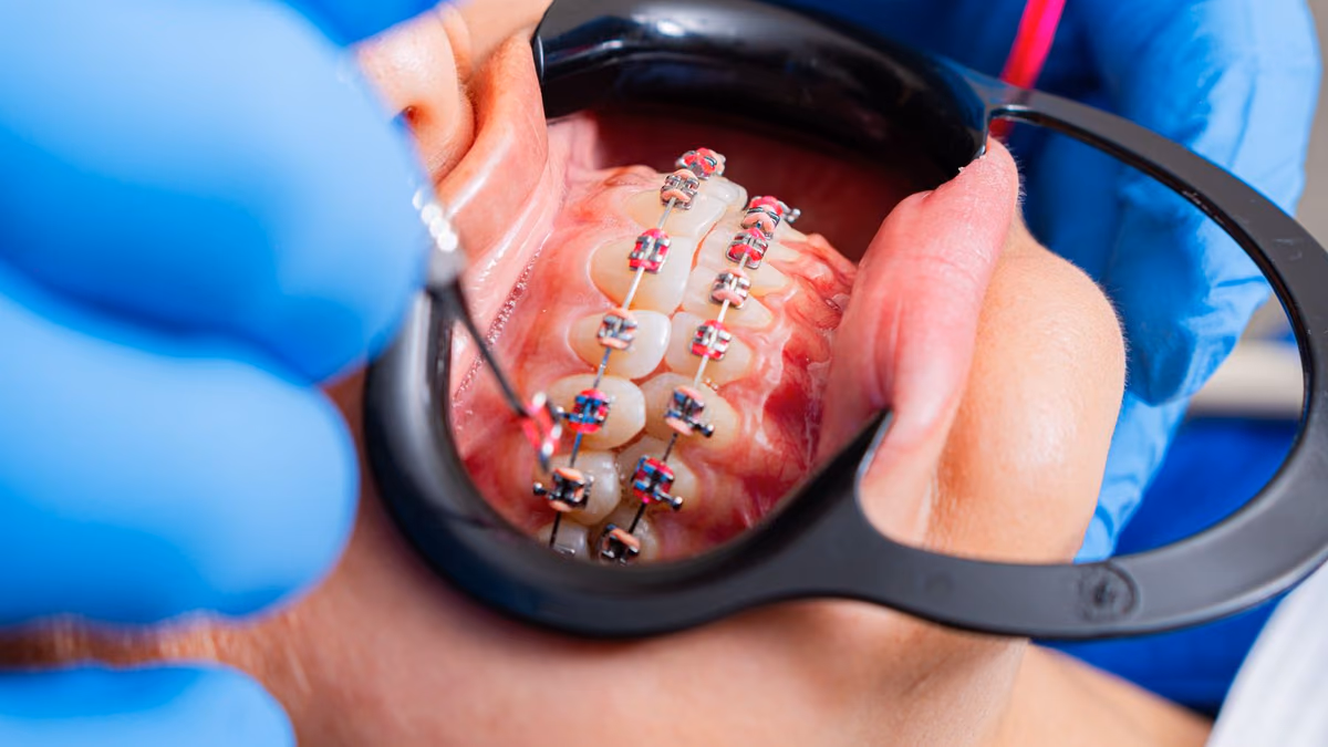 Close-up of a dentist adjusting fixed orthodontic brackets on a patient's teeth, the same technique used to fit tooth-coloured ceramic braces.