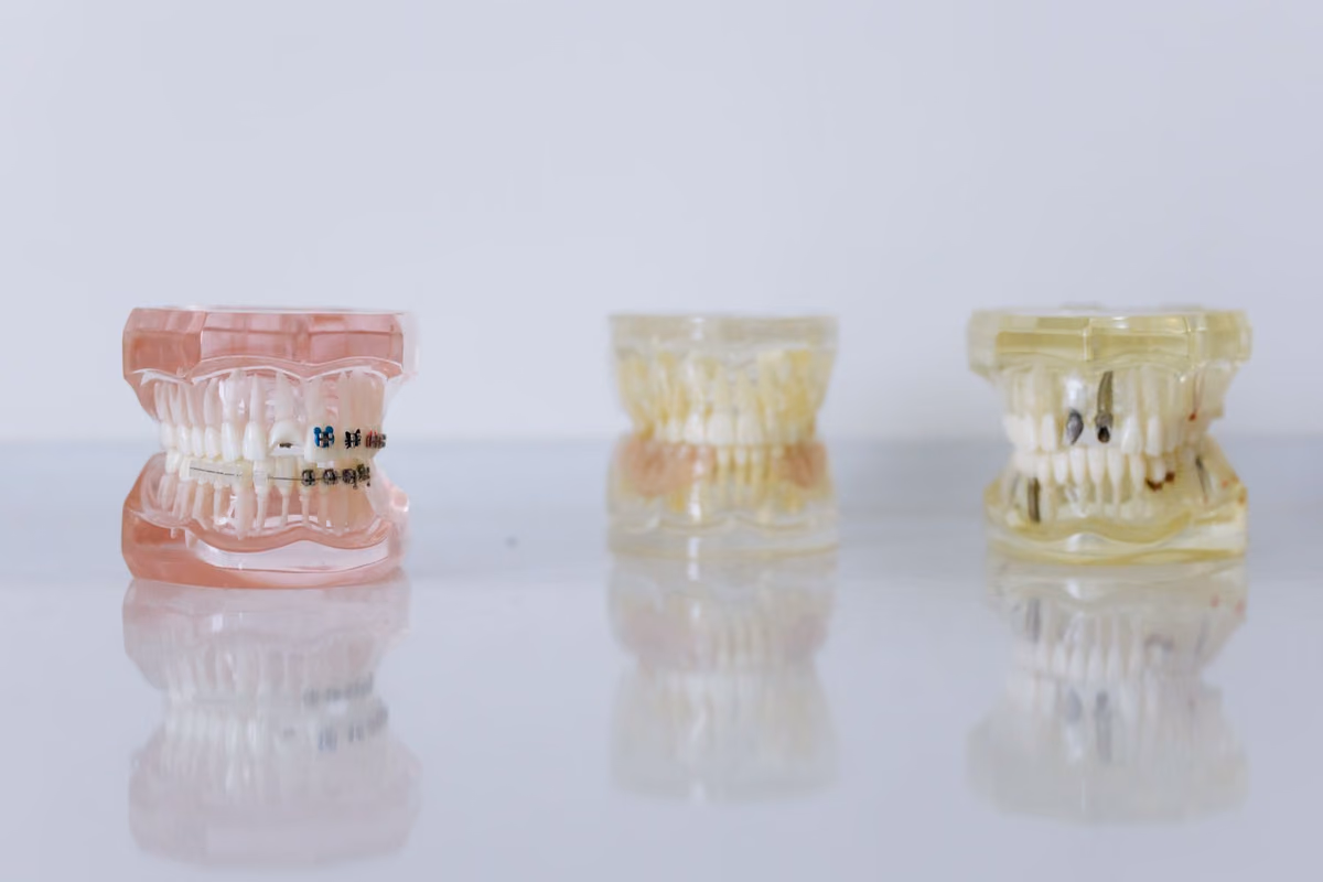 Dental study models fitted with different orthodontic appliances side by side, used to compare how each type of braces looks in the mouth.