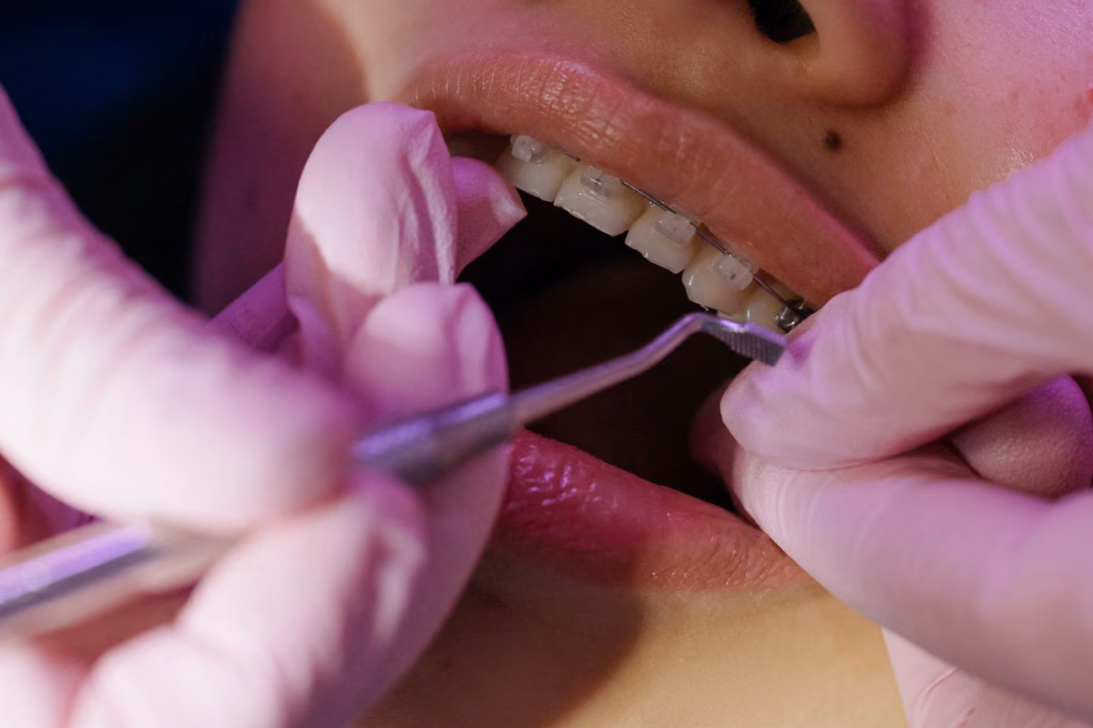 A dentist working on orthodontic brackets during a fitting appointment, illustrating the precision required for braces bonded behind the teeth.